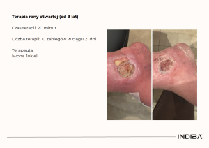 INDIBA W LECZENIU OWRZODZEŃ PODUDZI