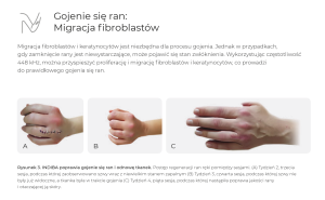 INDIBA I LECZENIE RAN
