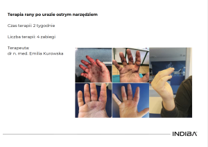 INDIBA WARSZAWA INDIBA WARSZAWA RANY OSTRYM NARZĘDZIEM